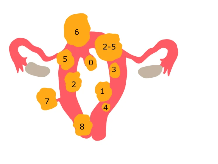 Figo Classification 