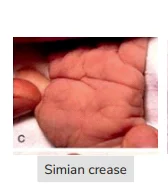 simian crease