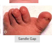 Sandle Gap