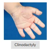 clinodactyly