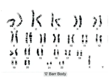 Symptoms Of Turner Syndrome