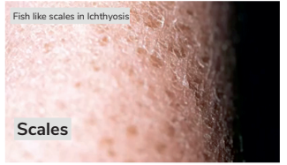 Ichthyosis Vulgaris