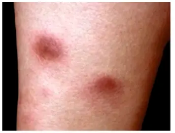 Erythema Nodosum
