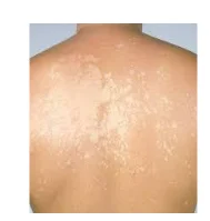 Pediatric Tinea Versicolor Clinical Presentation: History