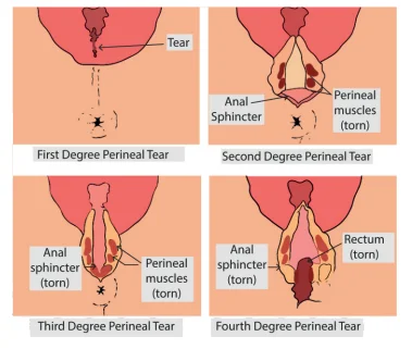 Episiotomy