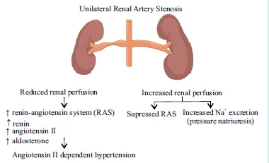 TWO KIDNEY, ONE CLIP MODEL (VASOCONSTRICTOR HYPERTENSIVE MODEL)