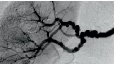 Median Fibroplasia