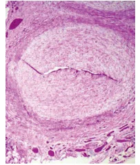 Pathology Kawasaki Disease