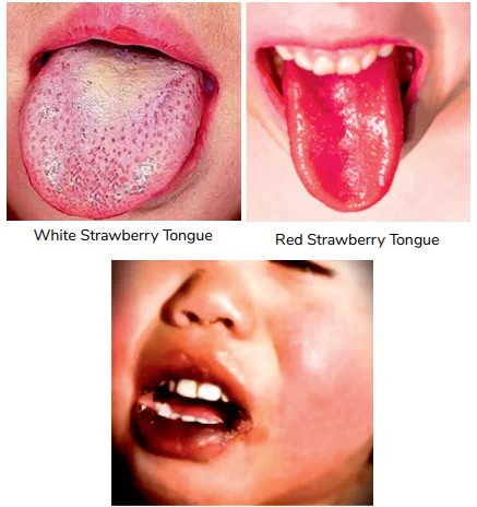 ORAL MUCOSAL CHANGES IN KAWASAKI DISEASE