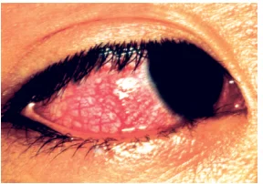 BILATERAL, NON-PURULENT CONJUNCTIVITIS