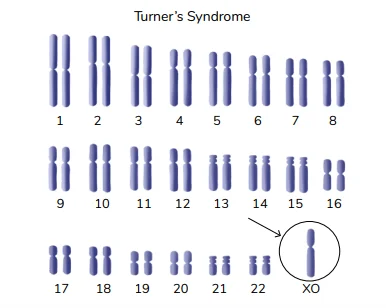 TURNER SYNDROME