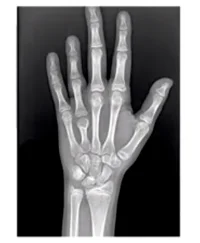 metacarpal sign