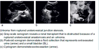 URINE LEAKS AND URINOMAS