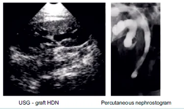 URETERAL OBSTRUCTION