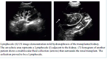 LYMPHOCELES