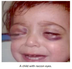 children with raccon eyes