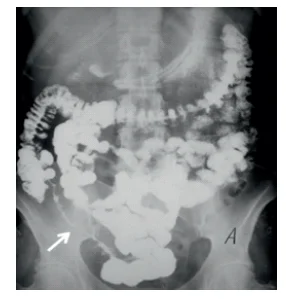 Image Based Question On Intestinal Obstruction PrepLadder Image Based Question On Intestinal Obstruction PrepLadder