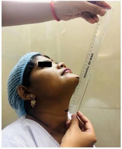 Thyromental Distance
