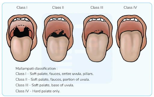 Mallampati Classification Respiratory IV Airway Management Flashcards