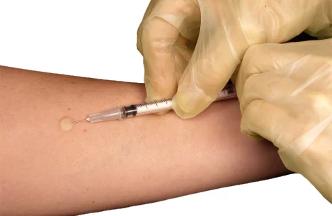 Mantoux test/Tuberculin test