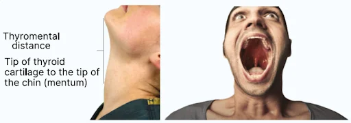 Things to do in Airway Assessment