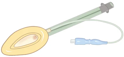 Laryngeal Mask Airway (LMA) 