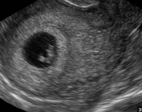 Intrauterine pregnancy