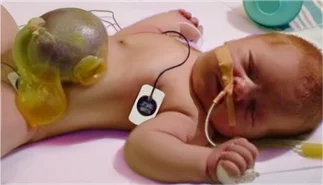Omphalocele