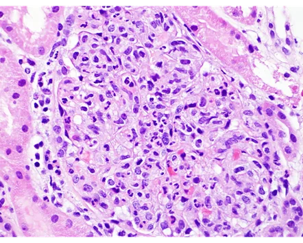 ​Membranous nephropathy
Image Based Question