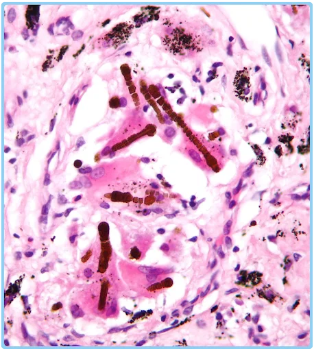 Ferruginous body

