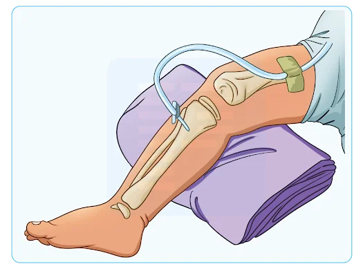 Intraosseous route access for giving IV fluids