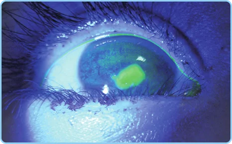 Fluorescein dye cobalt blue filter