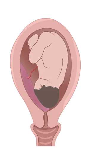 grade of placenta previa depicted
