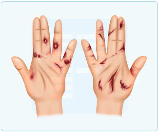 Defense wounds