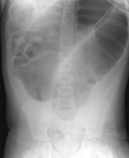 Sigmoid Volvulus
