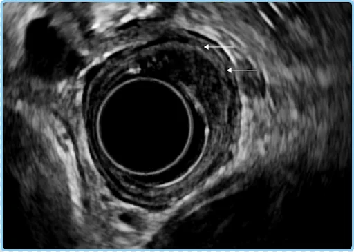 Staging of esophageal cancer
