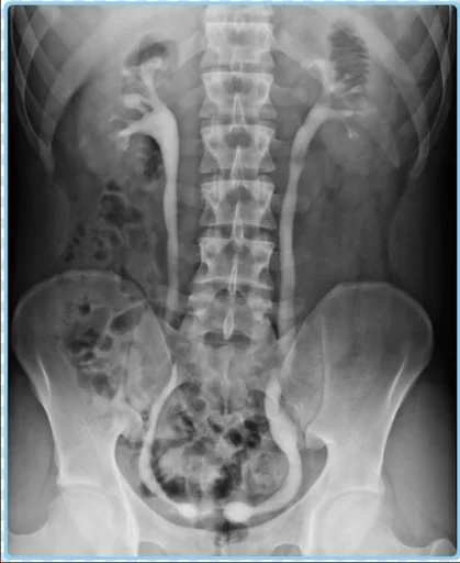 Intravenous Pyelogram (IVP)
