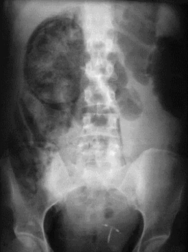 Emphysematous pyelonephritis
