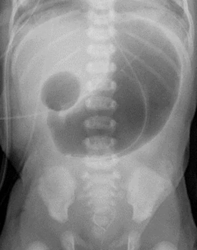 Double bubble sign
