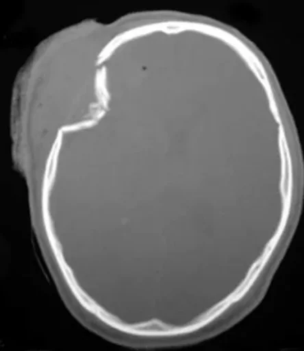 Depressed skull fracture