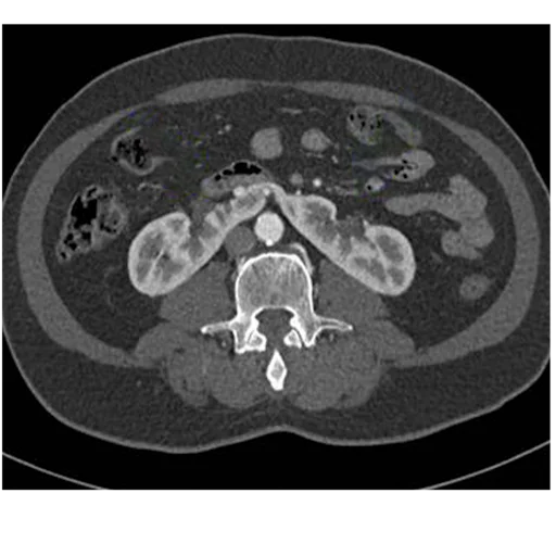Horseshoe kidney
