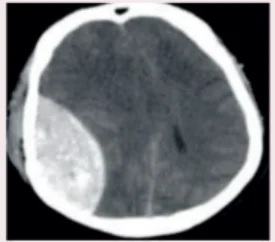Massive Epidural hemorrhage
