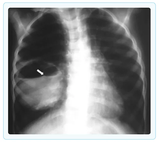 Hydatid cyst
