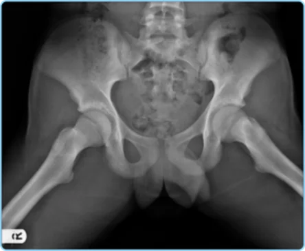 Slipped capital femoral epiphysis