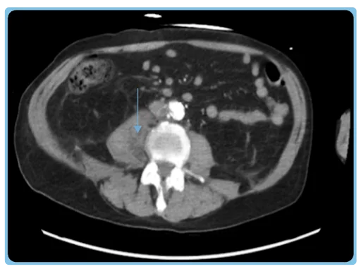 Psoas abscess
