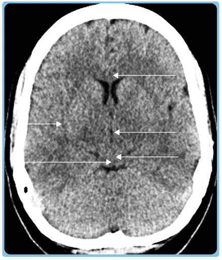 Midbrain
