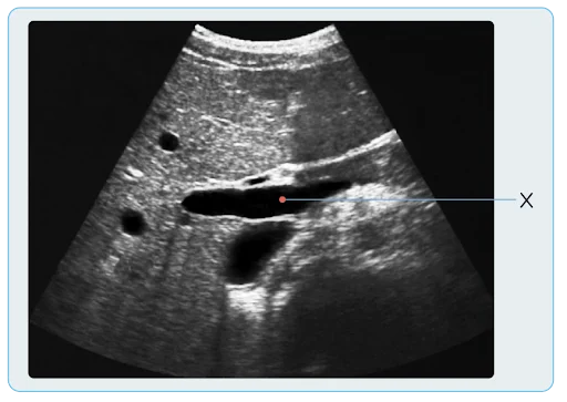 Portal vein
