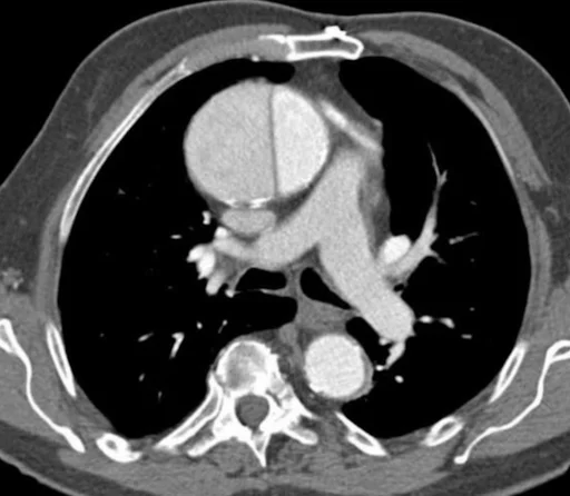 Aortic dissection
