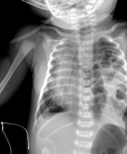 Diaphragmatic hernia
