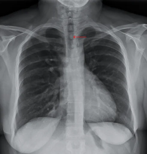 Trachea